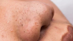 Understanding & Tackling Deep Blackheads: Your Essential Guide